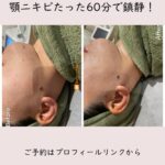 【プラズマシャワーでフェイスラインの大人ニキビが改善！】