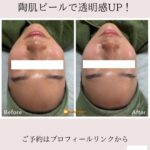 天王寺でニキビ跡ケア＆くすみケア可能です◎